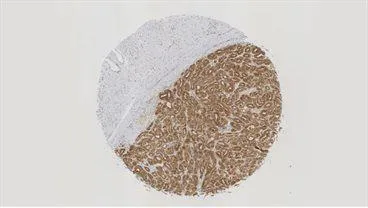 New potential avenues for cancer therapies through RNA-binding proteins